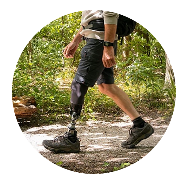 Prosthetic Solutions at Artificial Limb Centre