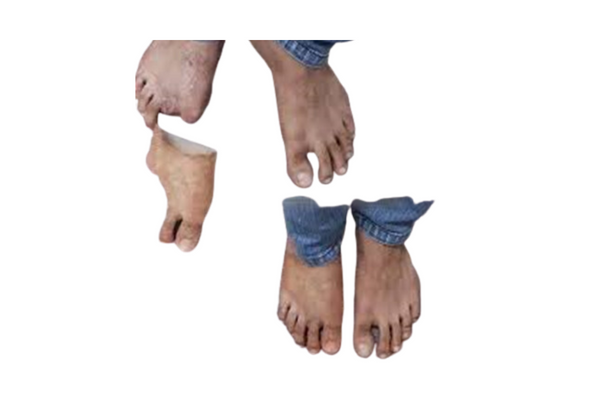 Partial Foot Prosthesis Solutoins and Cosmetic Restoration at ALC AMTZ